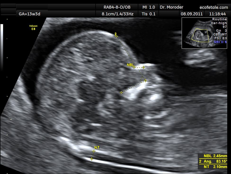 Ultrasound profile of a fetus around 13 weeks, with nuchal translucency and nasal bone measurements marked